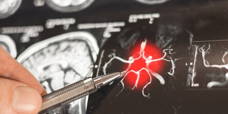 Promjene na mozgu kod Alzheimerove bolesti mogu početi sedam godina ranije nego što su naučnici mislili
