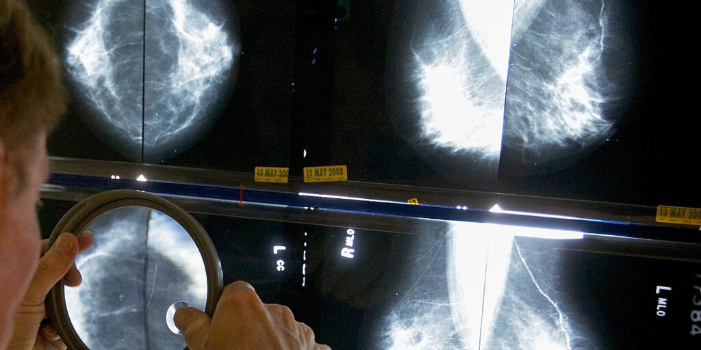 Kada započeti mamografiju? Različite preporuke otežavaju odluku ženama Kada započeti mamografiju? Različite preporuke otežavaju odluku ženama